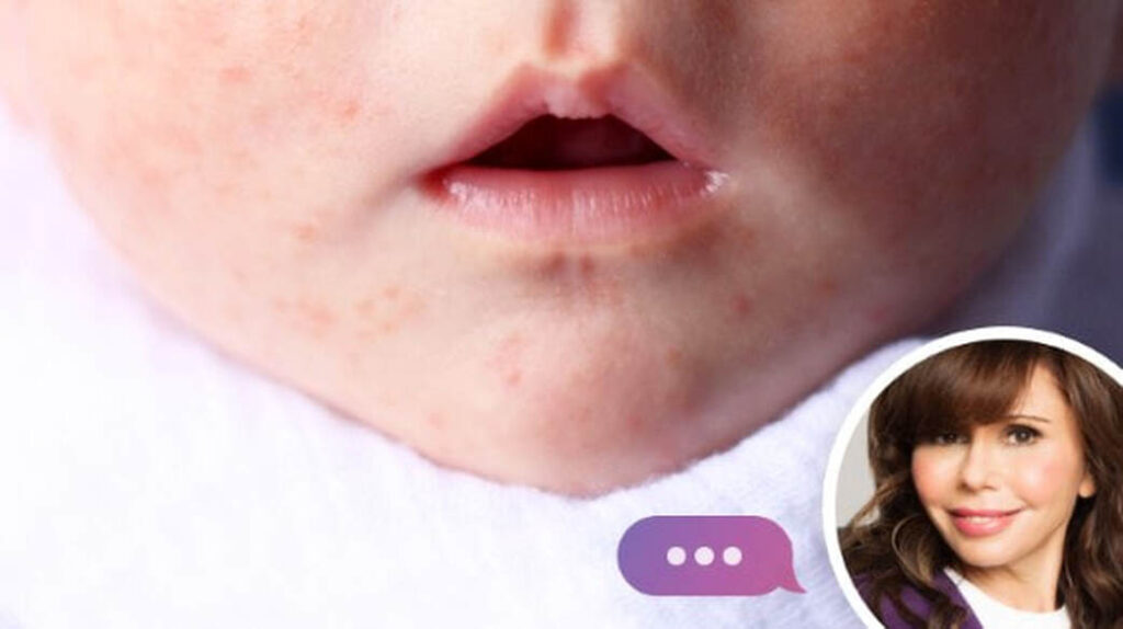 newborn-acne-issues-how-to-help